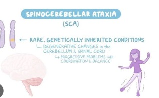 Spinocerebral ataxia