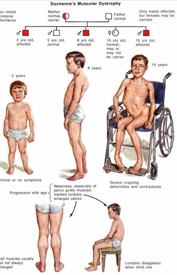 MUSCULAR DYSTROPHY