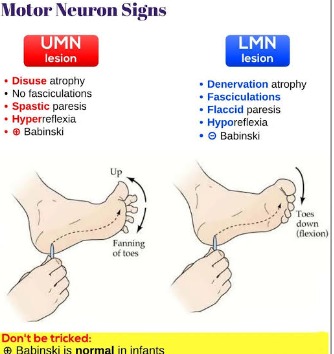 Difference between upper motor lesion and lower motor lesion